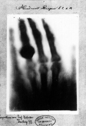 Roentgen hand photo